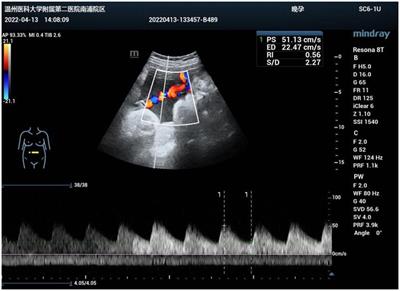 Case report: One case of umbilical vein thrombosis in the second trimester with associated portal vein thrombosis after childbirth